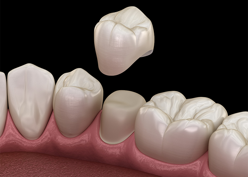 Restore your teeth with crowns & bridges in Bristol