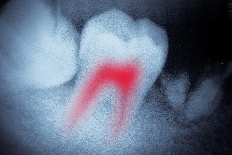 Endodontic Treatment in Bristol
