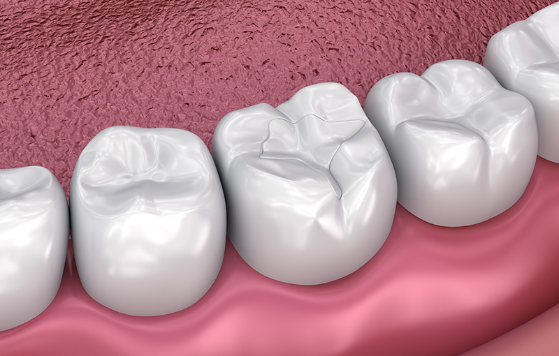 Protect your teeth with Fissure Sealants