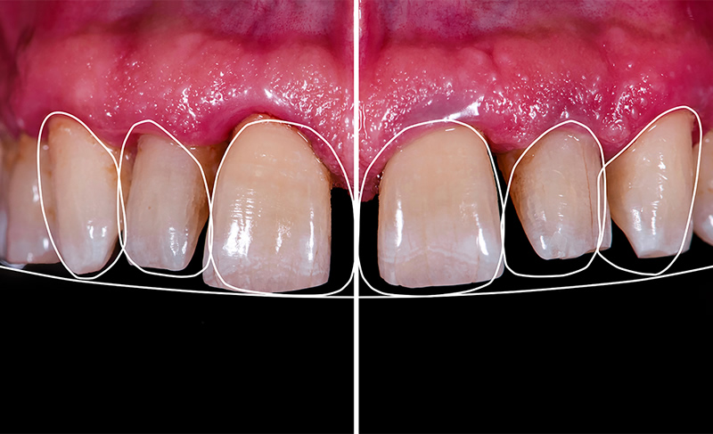 Improve your smile with Dental Veneers in Bristol