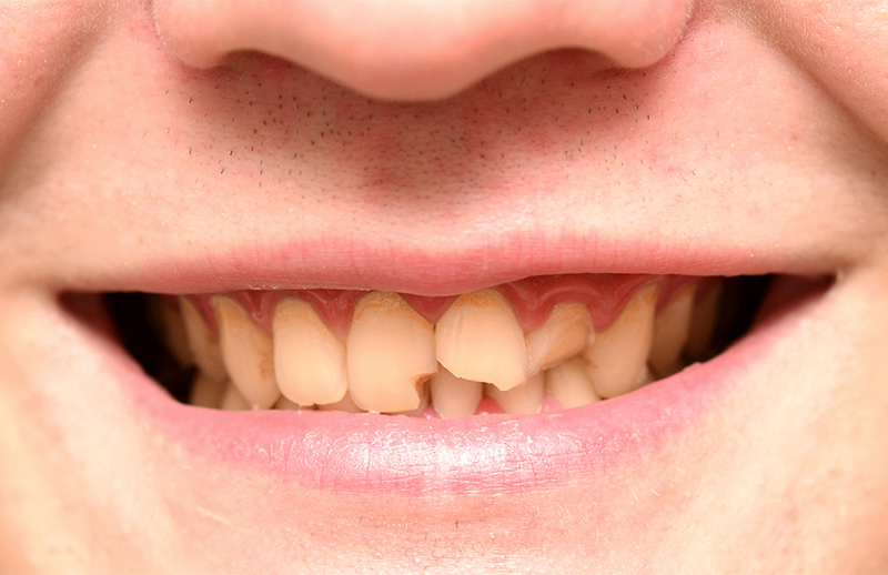 Restore teeth with Cosmetic Bonding in Bristol